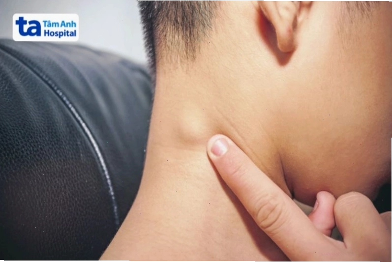 Hình ảnh hạch bạch huyết bị sưng