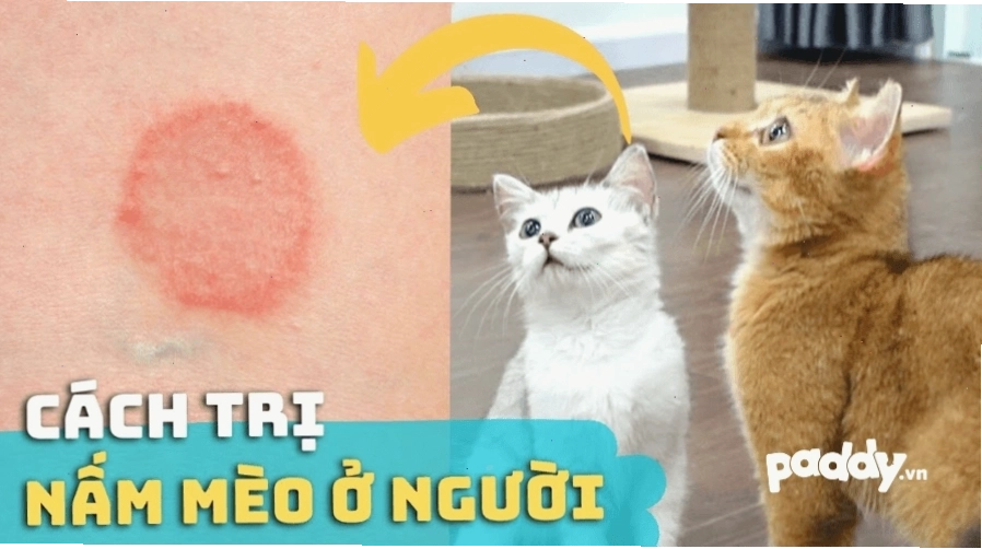 Hình ảnh minh họa bệnh nấm mèo ở người với các mảng đỏ trên da