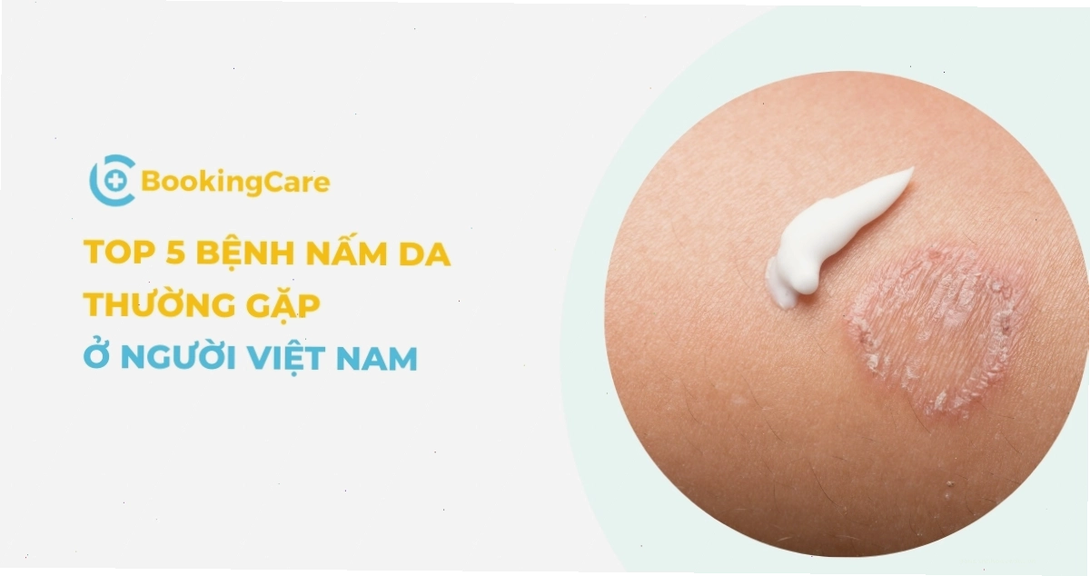 Hình ảnh minh họa các bệnh nấm da thường gặp ở người Việt Nam