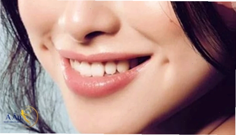 Hình ảnh minh họa má lúm đồng điếu là gì