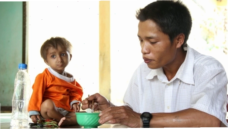 Hình ảnh minh họa một người mắc hội chứng Seckel với tầm vóc nhỏ bé đặc trưng