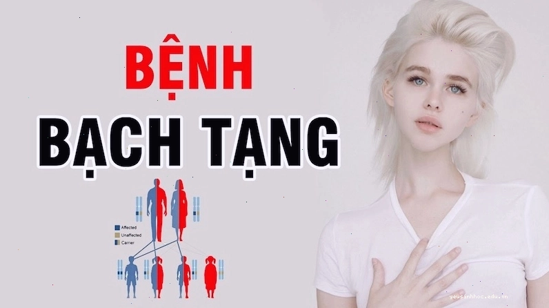 Hình ảnh minh họa người bệnh bạch tạng với màu da và tóc đặc trưng