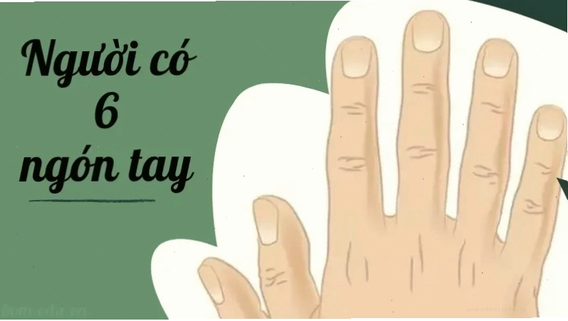 Hình ảnh minh họa người có 6 ngón tay