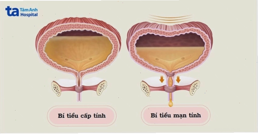 Hình ảnh minh họa tình trạng bí tiểu cấp tính và mãn tính ở người già
