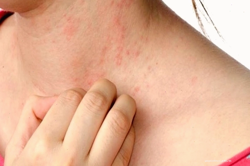 Hình ảnh minh họa tình trạng mề đay mẩn ngứa trên da