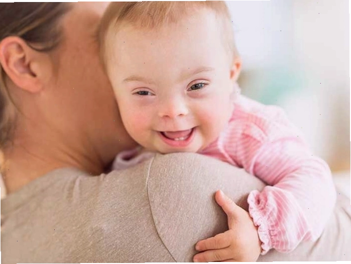 Hình ảnh minh họa trẻ em mắc hội chứng Down