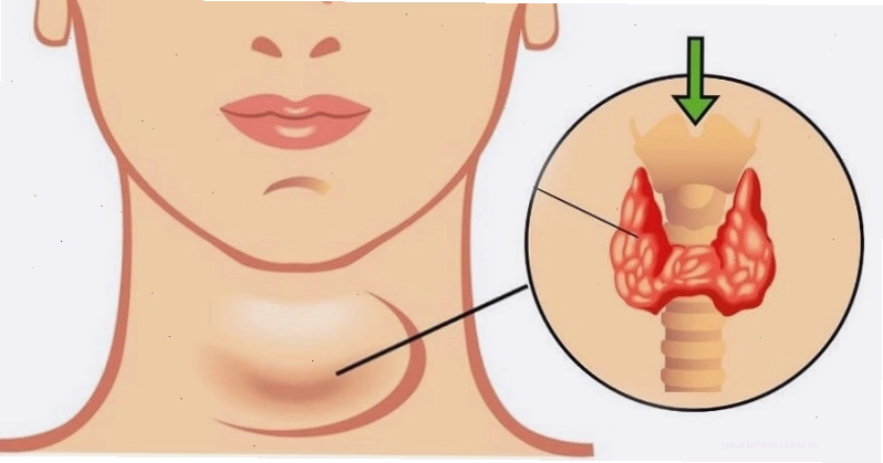 Hình ảnh minh họa tuyến giáp và ảnh hưởng của cường giáp