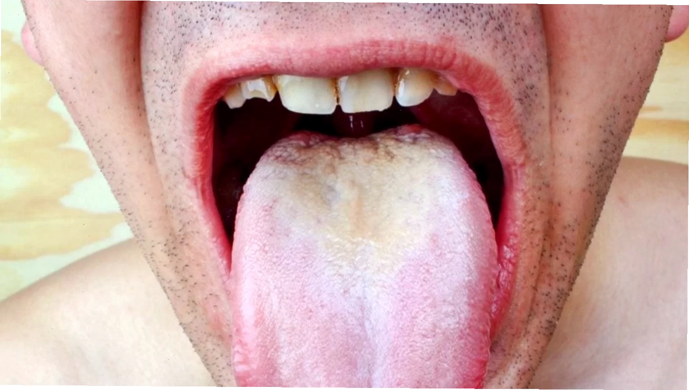 Hình ảnh nấm lưỡi với các mảng trắng đặc trưng trên bề mặt lưỡi