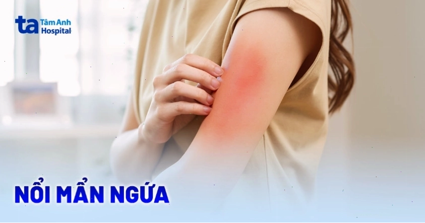 Hình ảnh người bị nổi mẩn ngứa khắp người với các nốt đỏ trên da