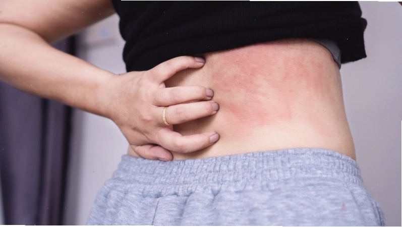 Hình ảnh người viêm da cơ địa đang được điều trị bằng thuốc bôi
