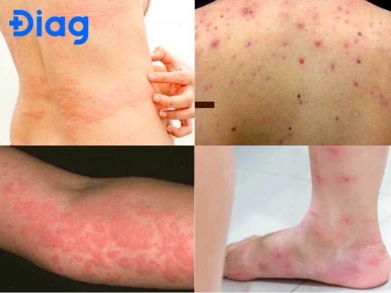 Hình ảnh nổi mẩn ngứa khắp người do dị ứng với thuốc bôi ngoài da