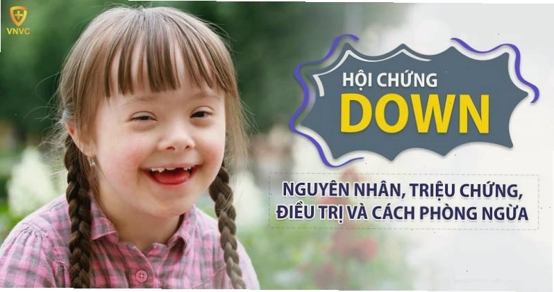 Hình ảnh trẻ em mắc hội chứng Down với các đặc điểm ngoại hình điển hình