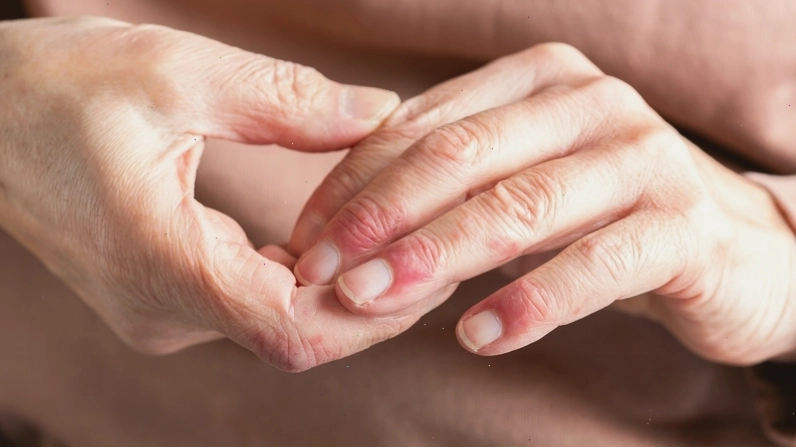 Hình ảnh viêm da cơ địa người lớn với các mảng đỏ và da khô ráp