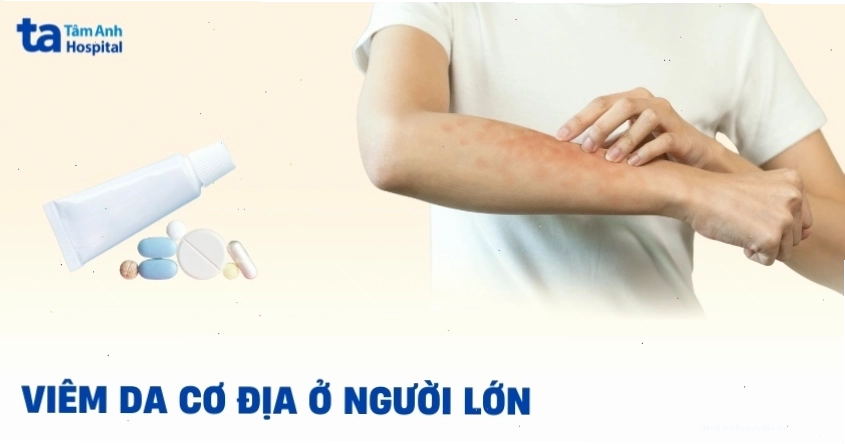 Hình ảnh viêm da cơ địa ở người lớn