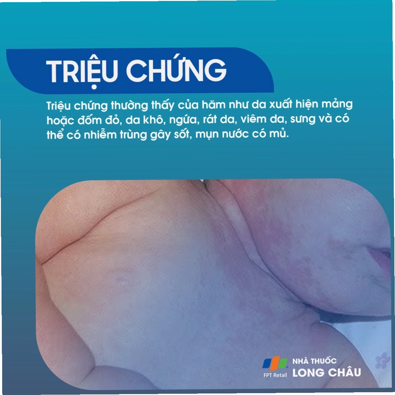 Kem bôi trị hăm nách giúp làm dịu da và giảm viêm