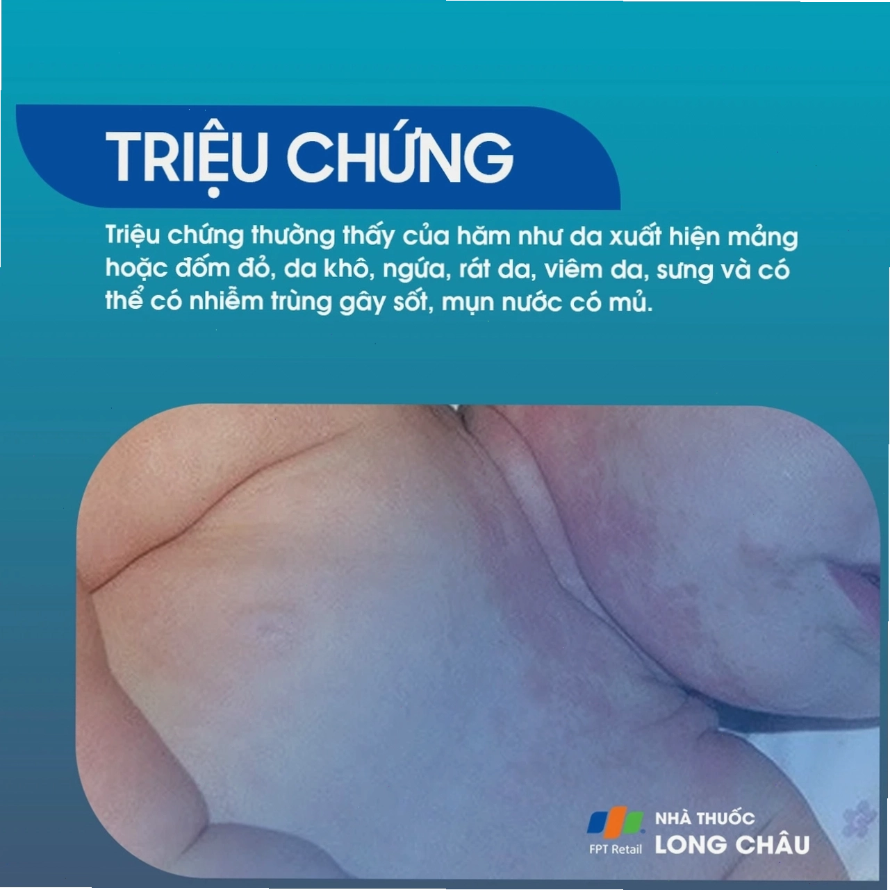 Kem trị hăm da dành cho người lớn