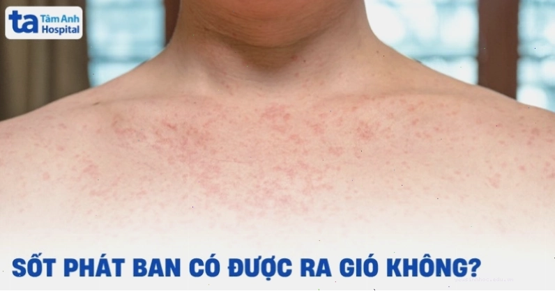 Khi bị sốt phát ban, người lớn cần tránh ra gió và giữ ấm cơ thể