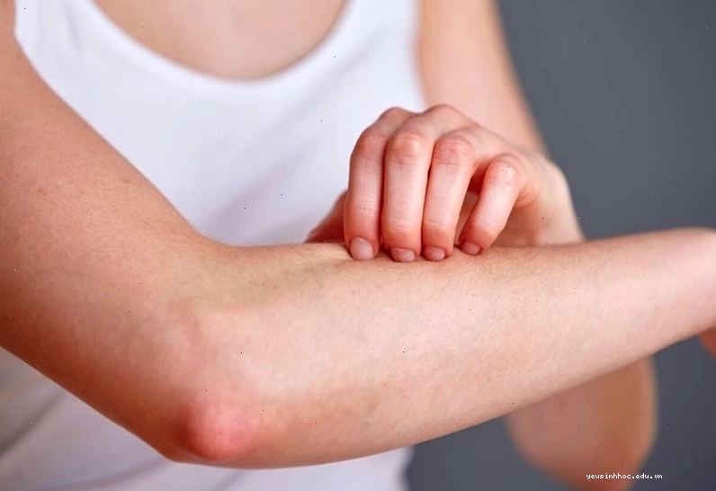 Không nên gãi nhiều để tránh tổn thương cho da