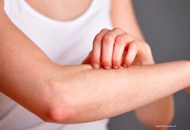 Không nên gãi nhiều để tránh tổn thương cho da