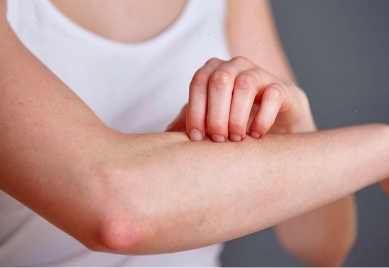 Không nên gãi nhiều khi bị ngứa để tránh tổn thương da