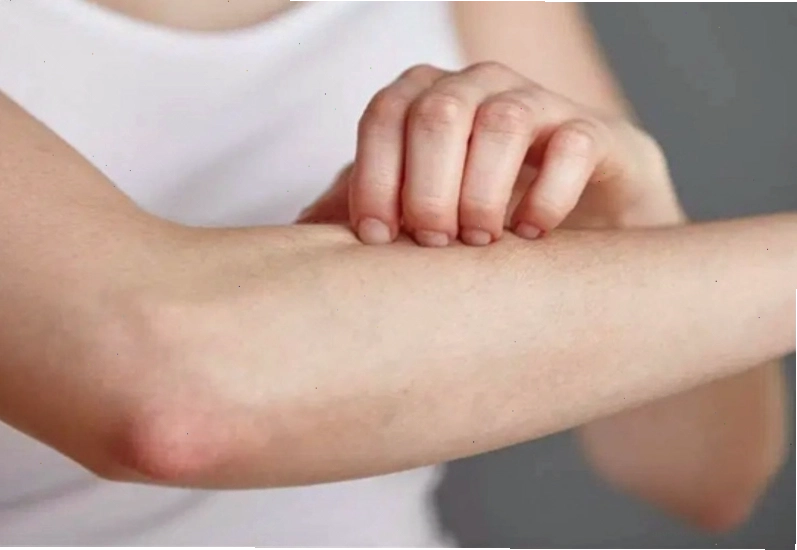 Không nên gãi vùng da bị rôm sảy để tránh làm tổn thương da