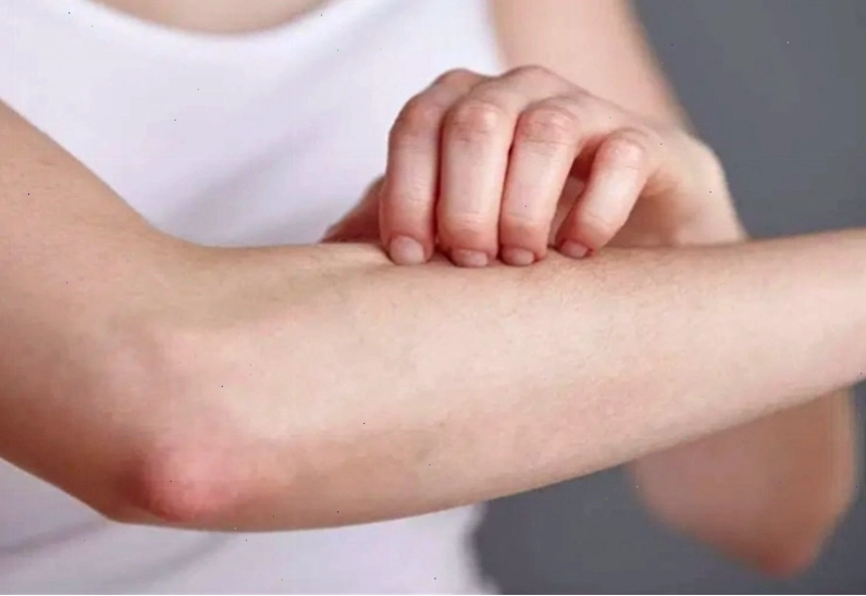 Không nên gãi vùng da bị rôm sảy để tránh tổn thương và nhiễm trùng