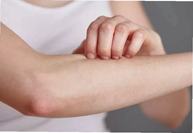 Không nên gãi vùng da bị rôm sảy ở người lớn
