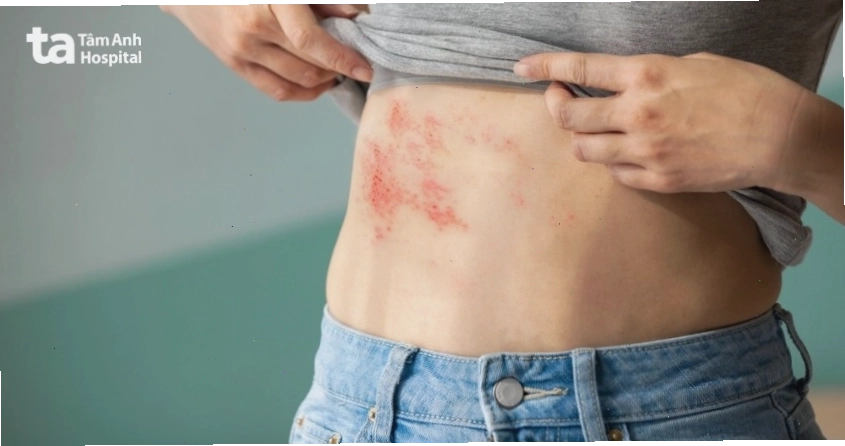 Kiểm soát căng thẳng giúp phòng ngừa các vấn đề về da