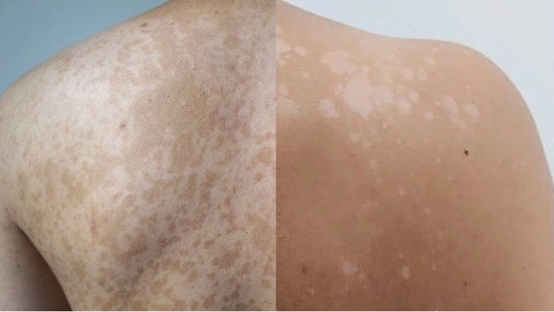 Lang ben có thể là những đốm da có màu sáng hoặc tối hơn da bình thường