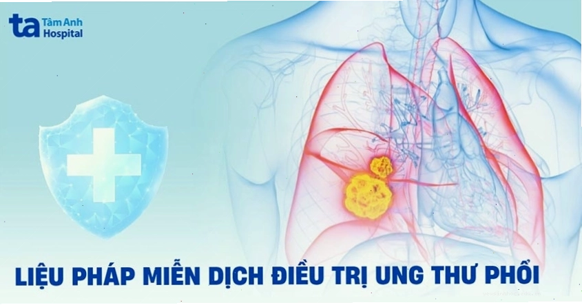 Liệu pháp miễn dịch trong điều trị ung thư phổi