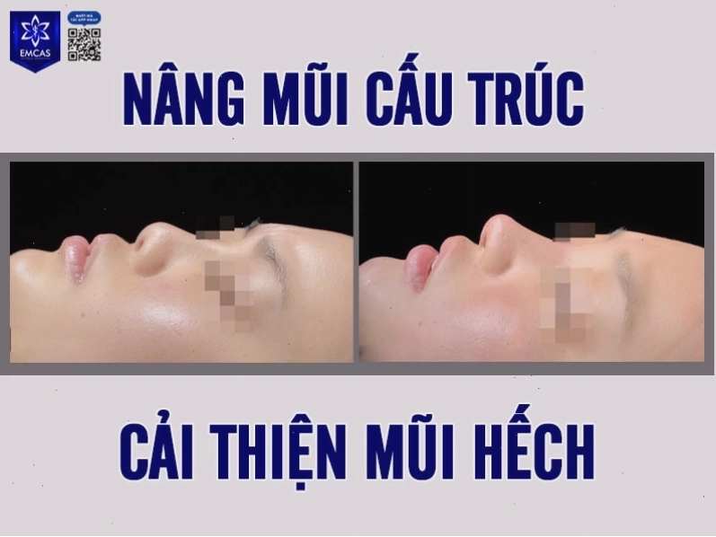 Lời khuyên về việc có nên sửa mũi hếch hay không