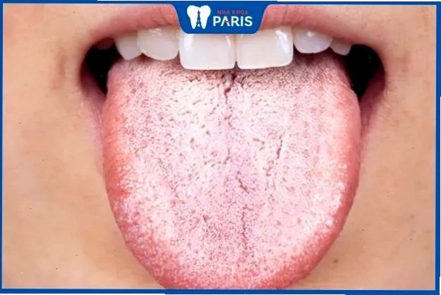 Lưỡi người lớn với các đốm trắng