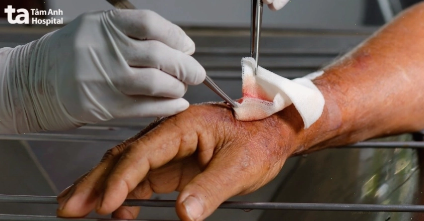 Lưu ý khi điều trị mụn thịt