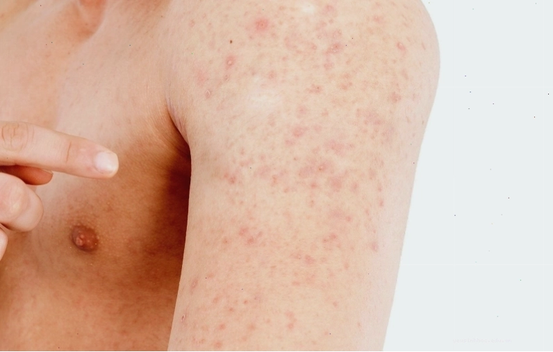 Mặc quần áo rộng rãi, thoáng mát giúp phòng ngừa rôm sảy ở người lớn