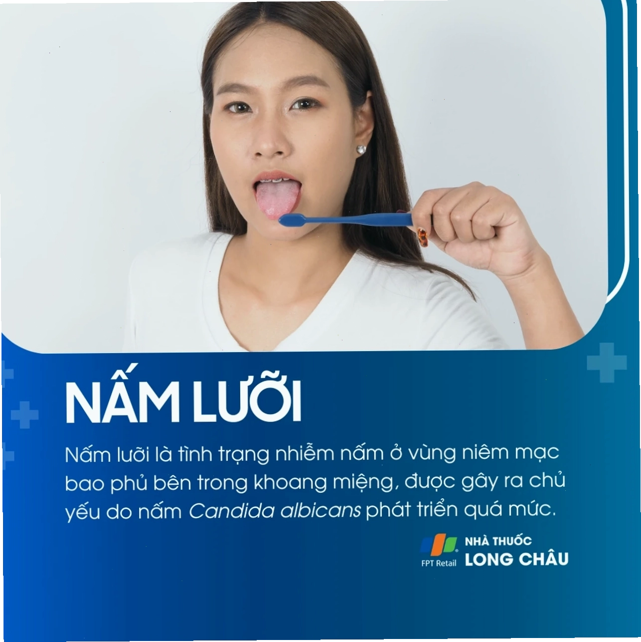 Mảng trắng đặc trưng trên lưỡi do nấm lưỡi ở người lớn