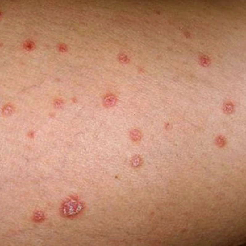 Môi trường sống ẩm thấp và vệ sinh kém là một trong những nguyên nhân gây nấm mèo ở người