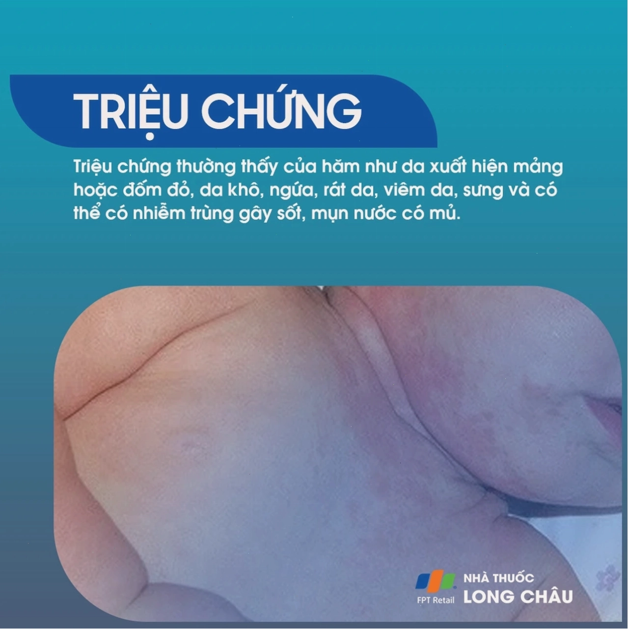 Một loại thuốc bôi trị hăm háng được đóng gói cẩn thận