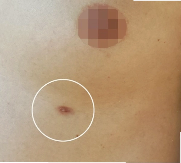 Một người phụ nữ có ba vú, thể hiện sự hiếm gặp của dị tật polymastia