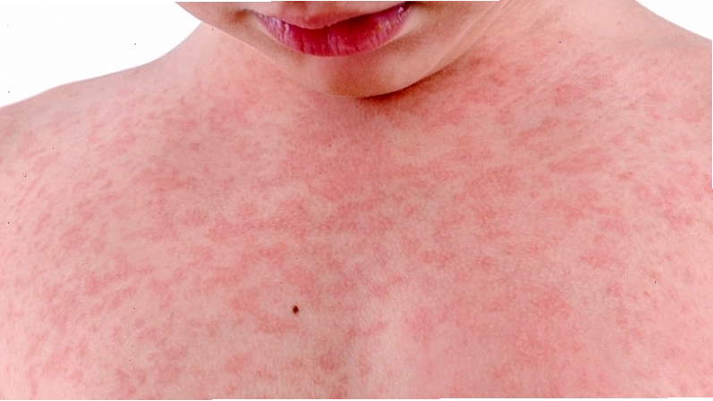 Một số cách trị nổi mẩn đỏ ngứa tại nhà hiệu quả