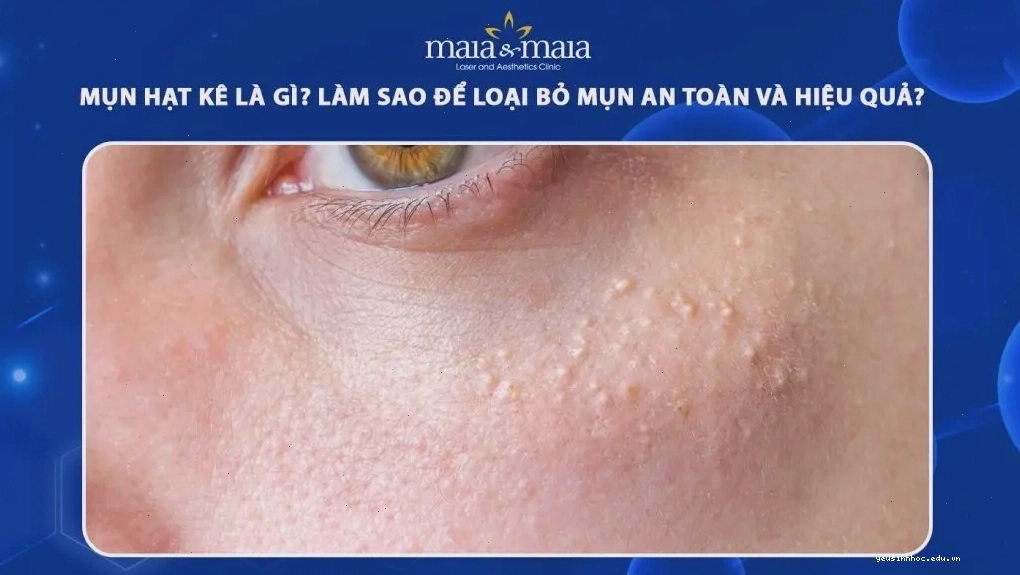 Mụn hạt kê có màu trắng hoặc vàng nhạt