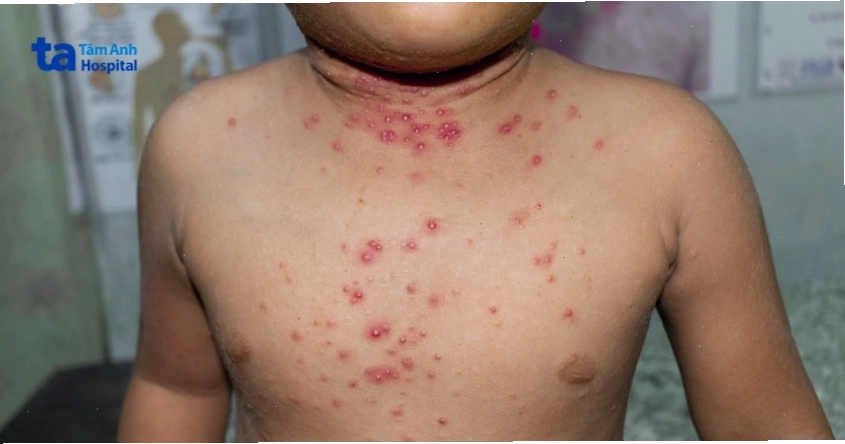 Mụn nước là triệu chứng điển hình của bệnh ghẻ phỏng