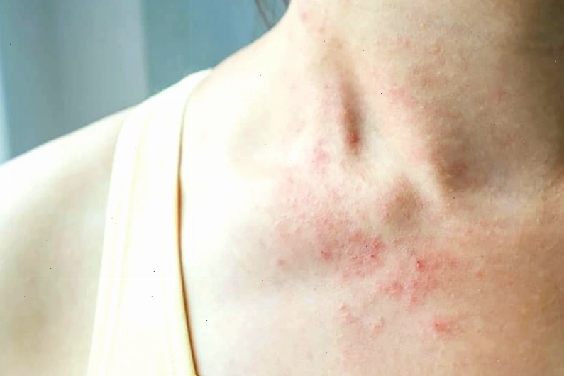 Mụn nước li ti trên da, biểu hiện của viêm da dị ứng