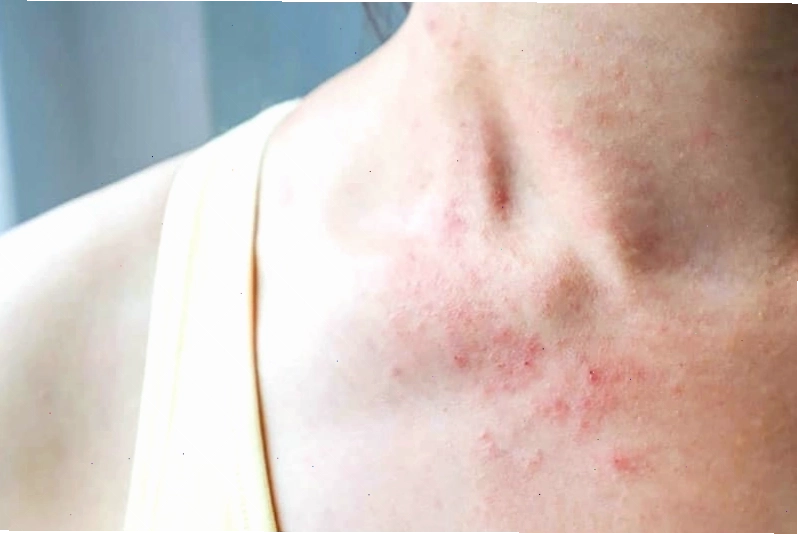 Mụn nước nhỏ xuất hiện trên da do nóng trong người