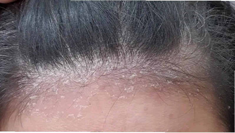 Nấm da đầu gây ngứa và rụng tóc nhiều