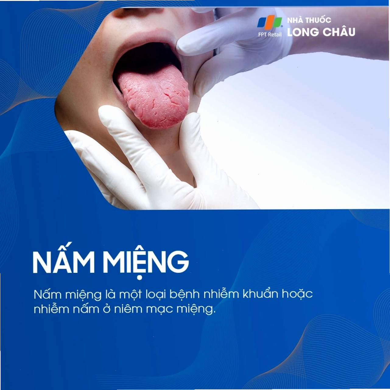 Nấm miệng gây khó chịu khi ăn uống