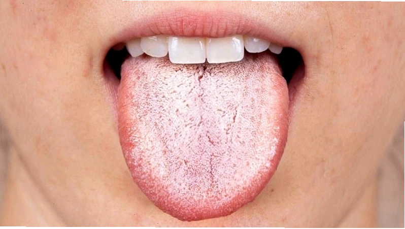 Nấm miệng là bệnh xảy ra khi có sự phát triển quá mức của nấm Candida albicans trong niêm mạc miệng