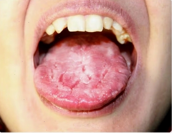 Nấm miệng với mảng trắng trên lưỡi