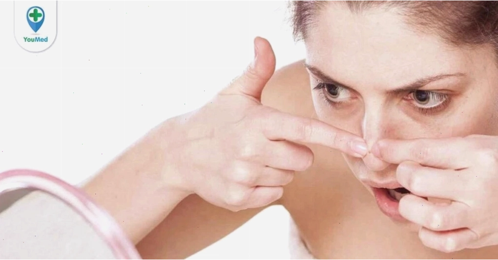 Nặn mụn trứng cá đúng cách để tránh tổn thương da và sẹo