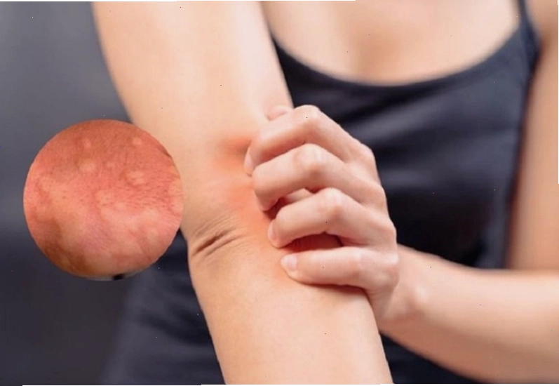 Ngứa da vào ban đêm khiến người bệnh rất khó chịu