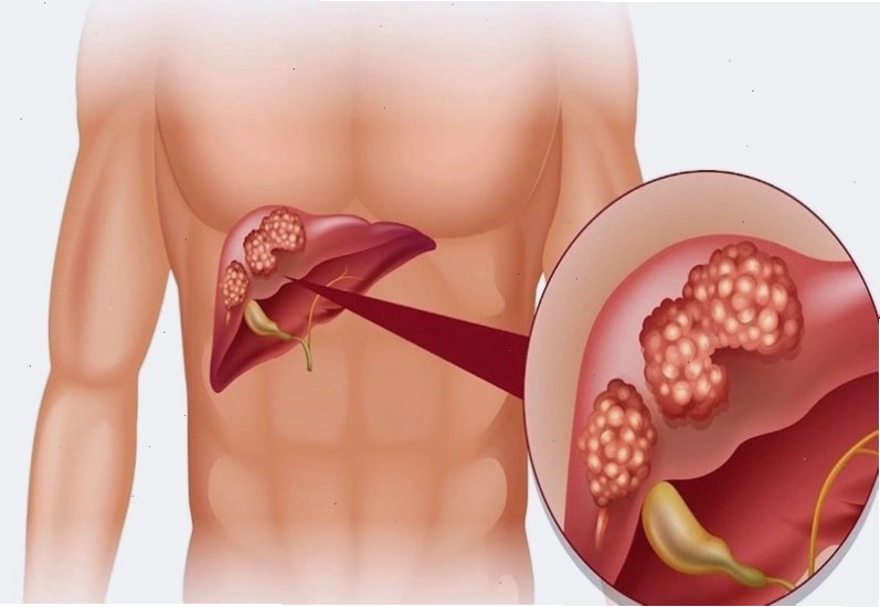Ngứa khắp người có thể là do bệnh lý về gan gây ra